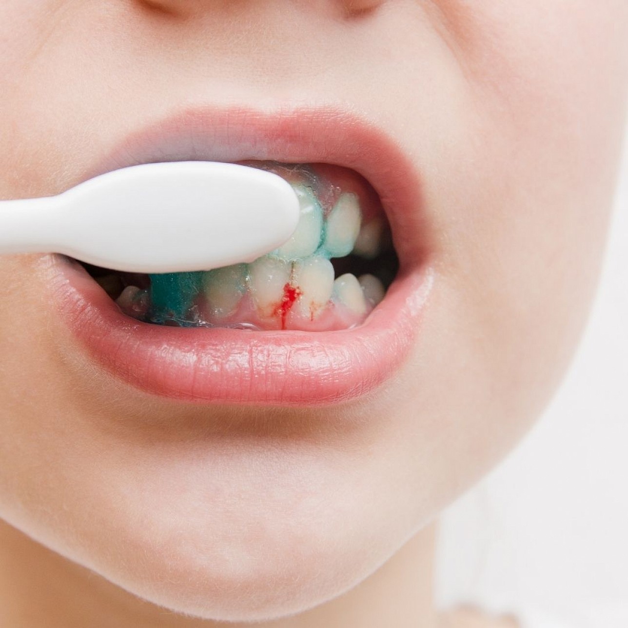 Néha vérzik az ínyed? Krónikus fogágybetegség jele lehet!